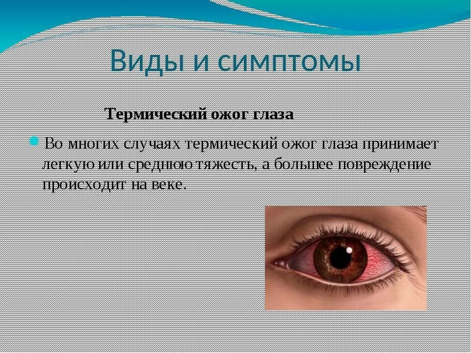 Что делать при термическом ожоге глаза. Термическая травма глаза. Симптомы при ожогах глаз.