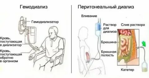 Диализ почек что