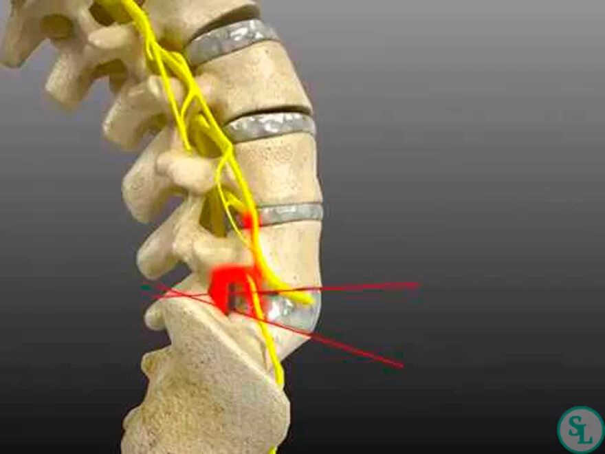 Дорзалгия. Диски l5-s1 в позвоночнике. Межпозвоночный диск l5-s1. Межпозвонковые диски l3-l4. Межпозвоночные диски l2-l3.