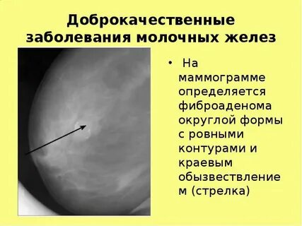 В правой стороне молочной железы