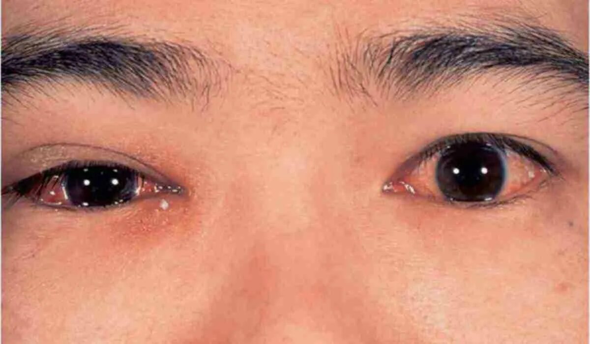 памятка по профилактике заболевания глаз. лечение заболеваний глаз. симптомы заболевания глаз. симптомы заболевания глаз. аденовирус кератоконъюнктивит.