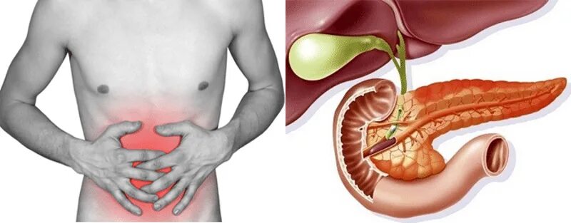 Панкреатит при боли в желудке. Панкреатит и панкреонекроз. Хронический панкреатит панкреонекроз. Панкреатит некроз поджелудочной железы.