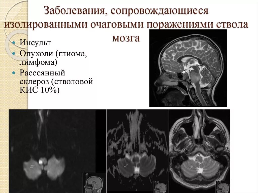 Поражение ствола головного. Поражение ствола головного мозга. Поражение ствола головного мозга симптомы. Инсульт ствола мозга мрт.