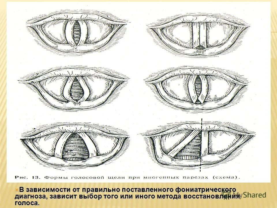 Функциональная афония. Гипертонусные нарушения голоса. Признаки гипертонусной дисфонии. Функциональная дисфония по гипотонусному типу. Гипертонусная дисфония