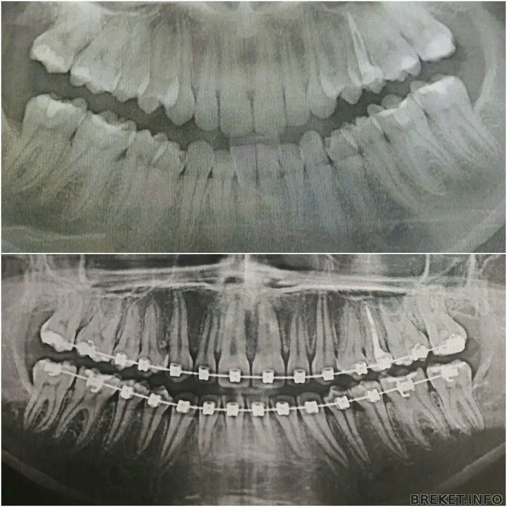 Панорамный снимок для ортодонта. Оптг кариес снимок зубов. Можно ли делать рентген с брекетами. Панорамный снимок зубов с брекетами. Панорамный снимок челюсти панорамный снимок (рентген) зубов.