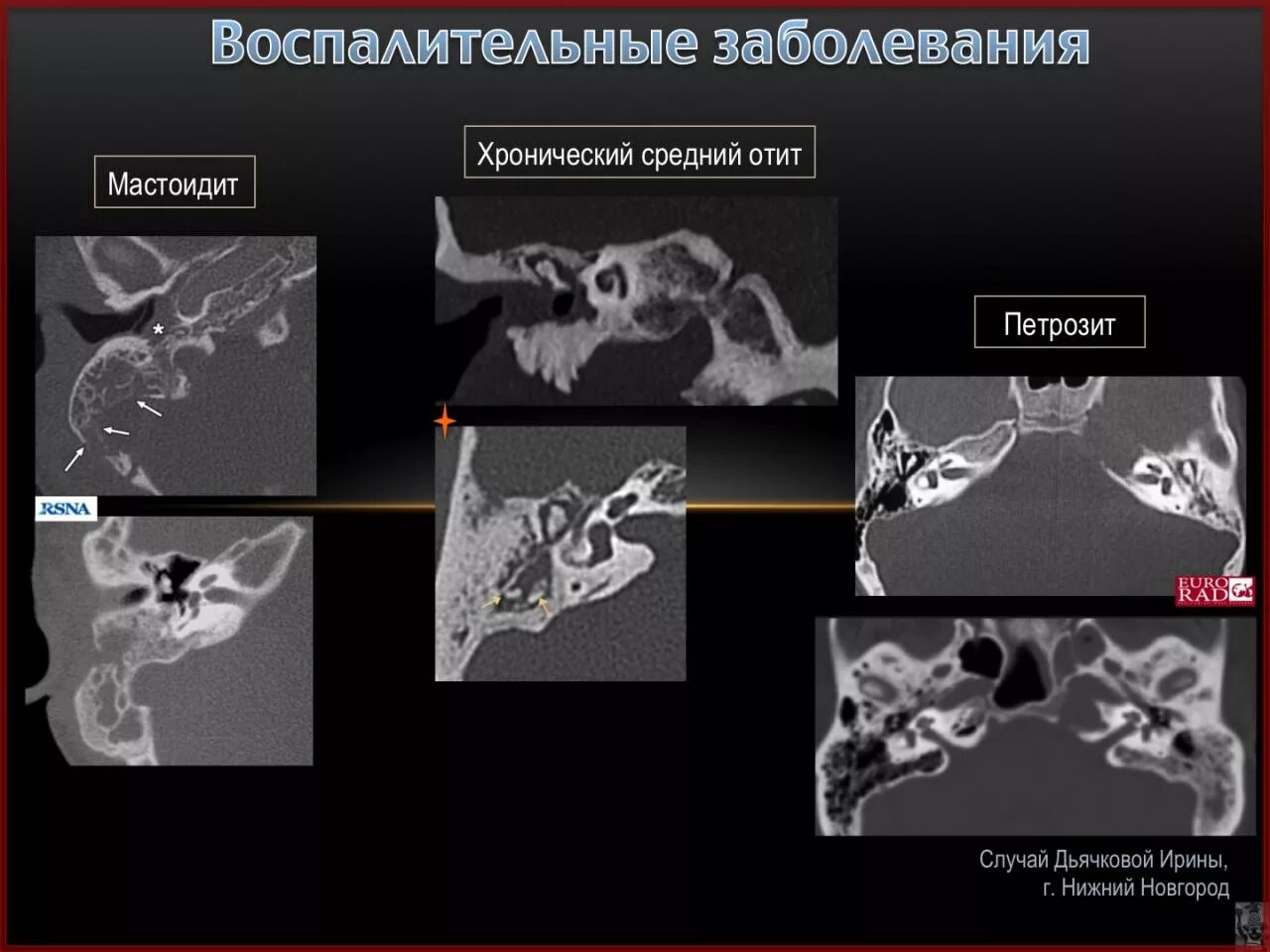 Холестеатома височной кости. Кт височных костей при отите. Холестеатома сосцевидного отростка мрт. Утолщение слизистой сосцевидного отростка