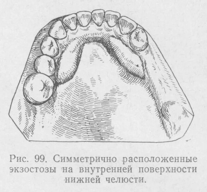 Костная основа полости рта. Фиброматоз альвеолярного отростка. Костные выступы нижней челюсти. Экзостоз альвеолярного отростка. Экзостоз слизистой полости рта.