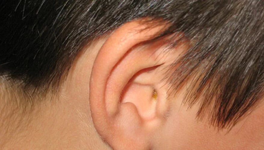 Как выглядит мочка уха. Растянутые ушные мочки уха. Отомикоз серная пробка. Ухо. Как выглядит мочка уха.