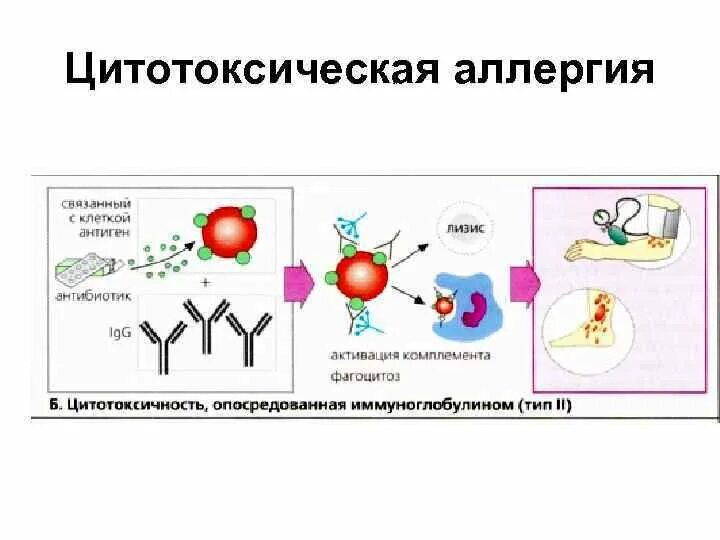 Аллергические реакции ii типа. Цитотоксический тип аллергической реакции схема. аллергическая реакция 2 типа.