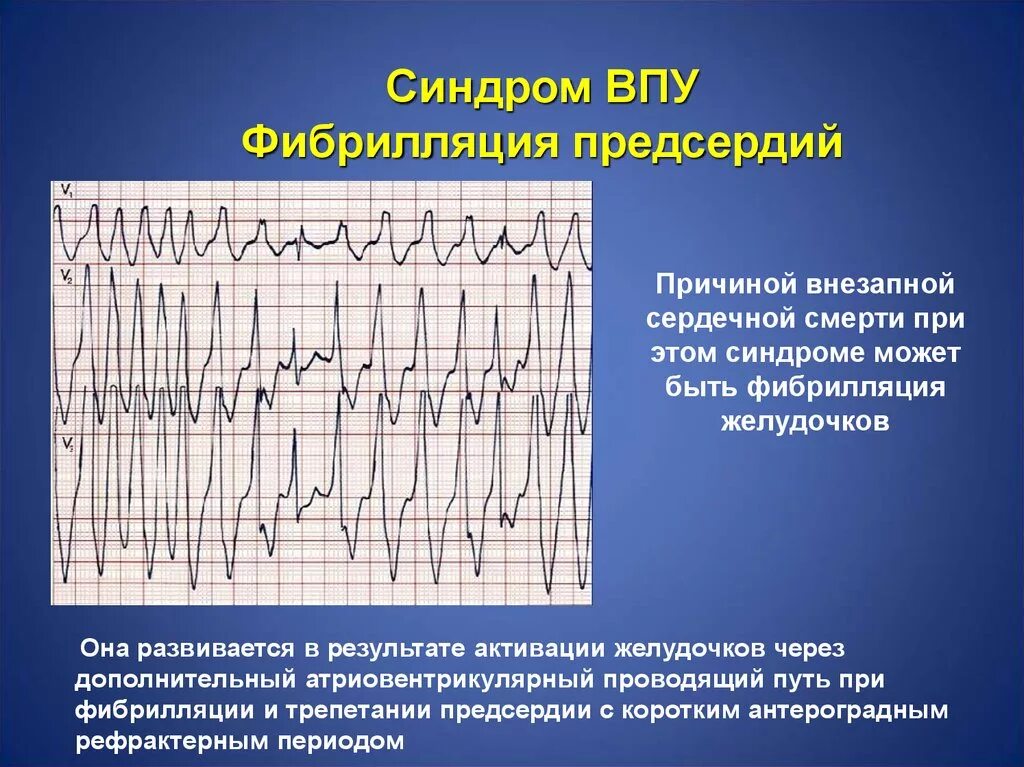 1. Фибрилляция желудочков.. Фибрилляция и трепетание предсердий на ЭКГ. Фибрилляция предсердий и желудочков на ЭКГ. Трепетание желудочков на ЭКГ.