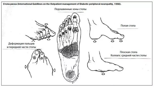 Синдром диабетической стопы стопа Шарко. Остеоартропатия стопа Шарко. Диабетическая нейроостеоартропатия стопы. Диабетическая стопа стопа Шарко.