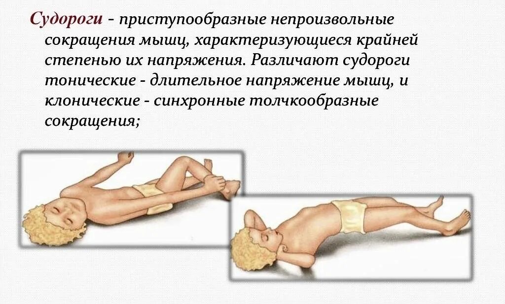 Припадок сна. Клонические судороги у новорожденного симптомы. Клонико-тонические судороги у новорожденных. Тонические судороги у детей причины. Клонические судороги у детей во сне.