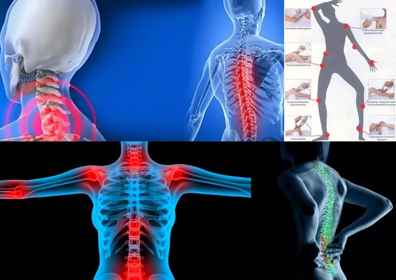 Защемление в пояснице симптомы. Остеохондроз защемление нерва шейного позвонка. Защемление грудного позвонка. Нервы в шейном отделе позвоночника.