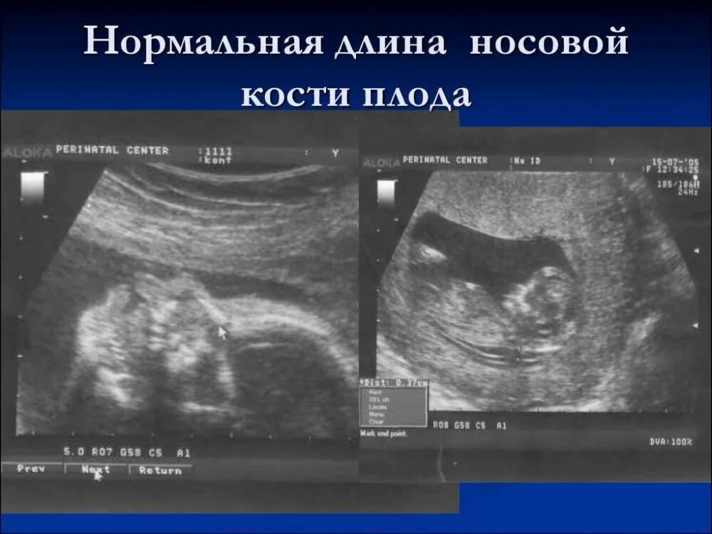 Воротниковое пространство норма. Носовая кость узи плода. узи носовой кости плода норма 13. узи носовой кости плода на 13 неделе беременности. узи носовой кости плода норма 13 недель.