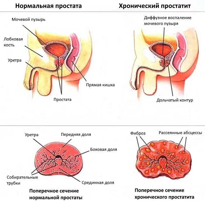 Воспалить простату. Хроническое воспаление предстательной железы. Хронический простатит. Проявления хронического простатита.