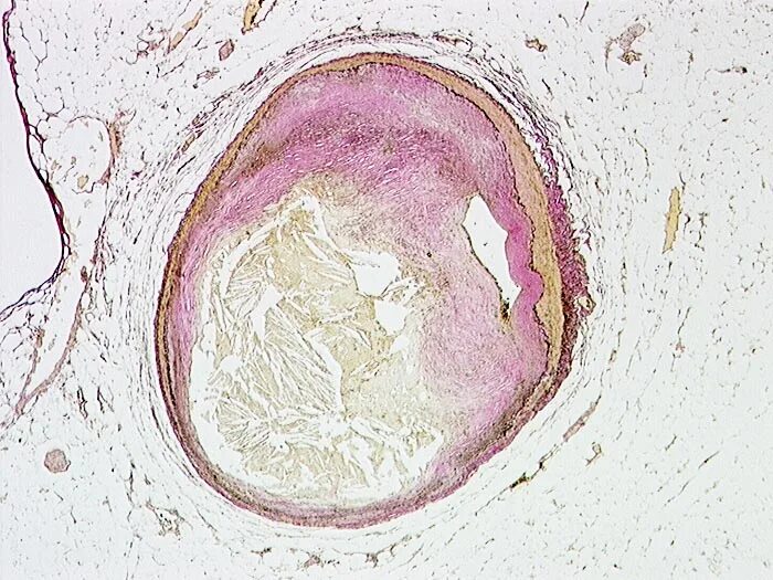 Белый тромб микропрепарат. Тромбофлебит гистология. Атеросклероз венечной артерии гистология. Белый тромб макропрепарат. Тромб микропрепарат