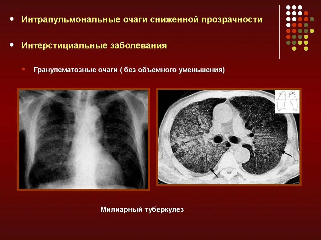 Лучевые заболевания легких. Заболевания легких рентгенология. Рентгенодиагностика заболеваний легких. Гранулематозные очаги. Лучевая диагностика заболеваний легких.