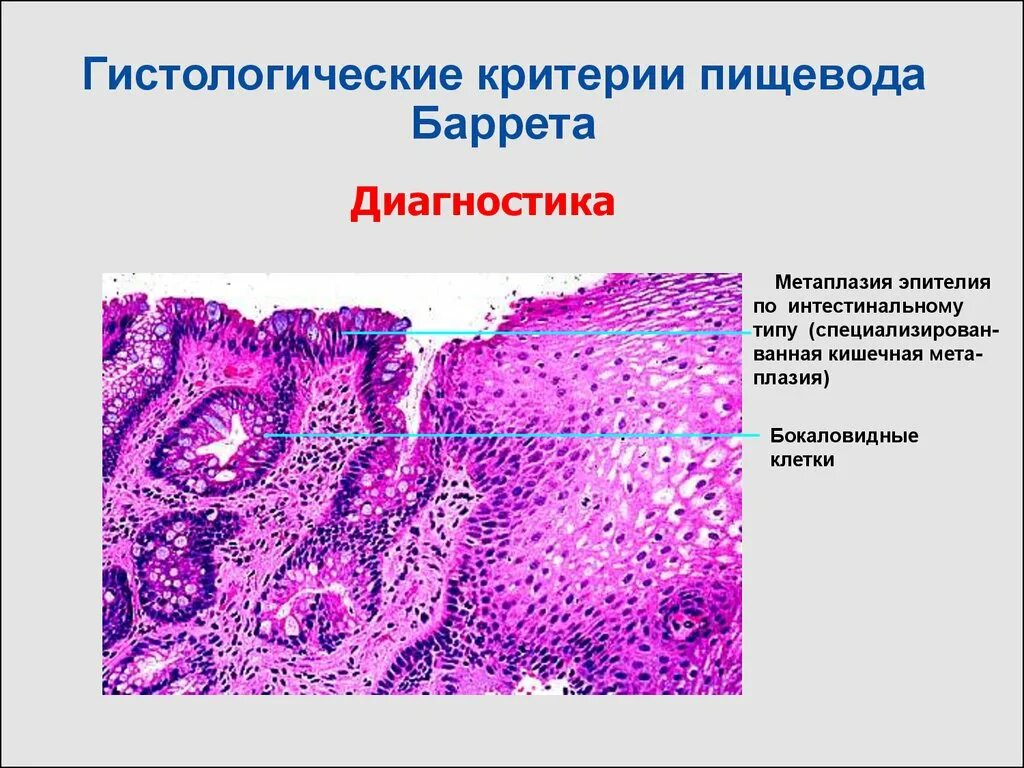 Группы клеток метаплазированного. Пищевод Барретта гистология. Метаплазия пищевода гистология. Пищевод Барретта метаплазия эпителия. Толстокишечная метаплазия гистология.