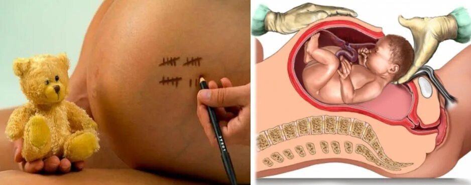 Возможно ли родить с