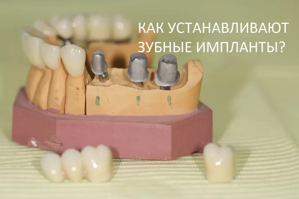 Вставить зуб пермь