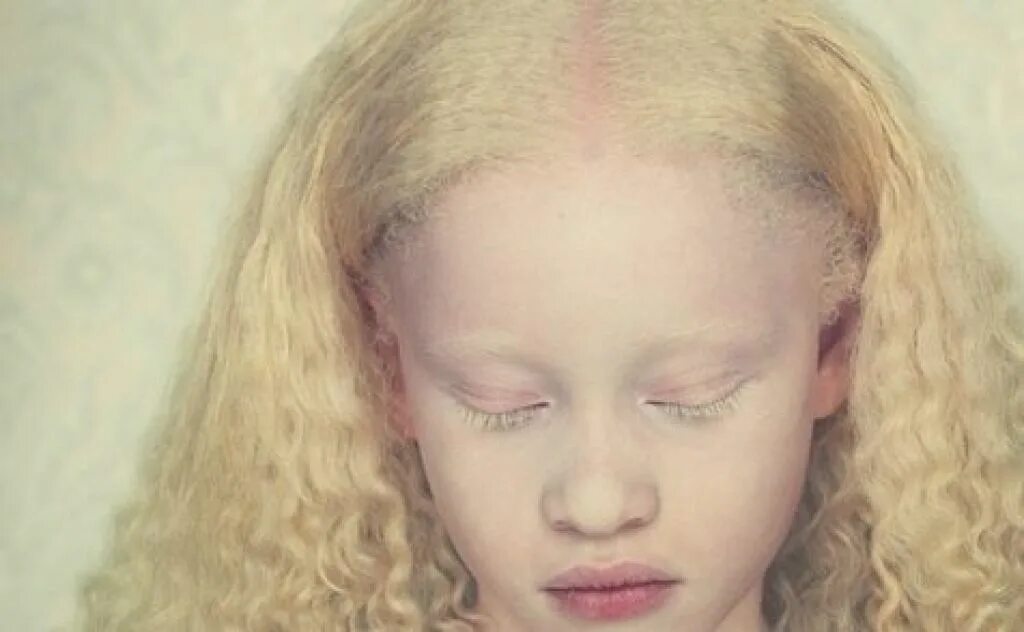 Глазокожный альбинизм Тип 1а. Люди альбиносы с красными глазами. Альбинизм это геномная мутация. Альбинизмом страдают