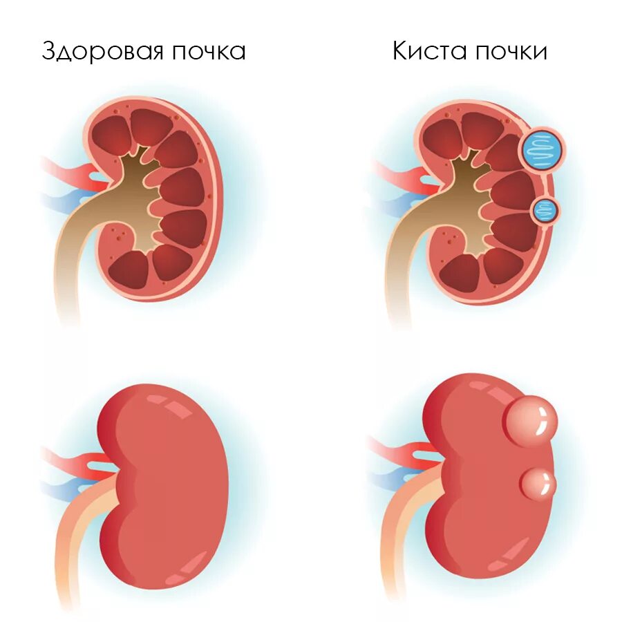 Киста на почке у мужчины лечение