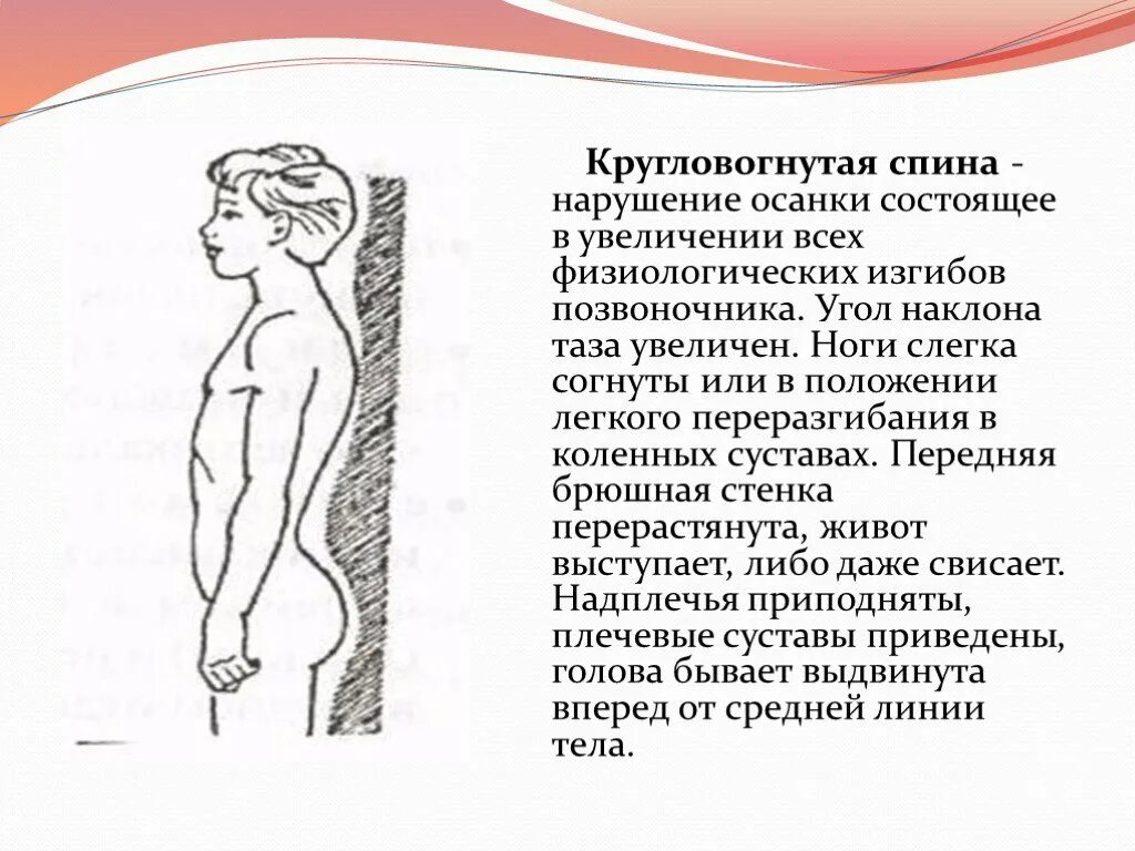 Осанка круглая спина. Плоская спина. Вогнуто круглая спина. Кругловогнутая осанка. Круглая спина разновидность осанки.