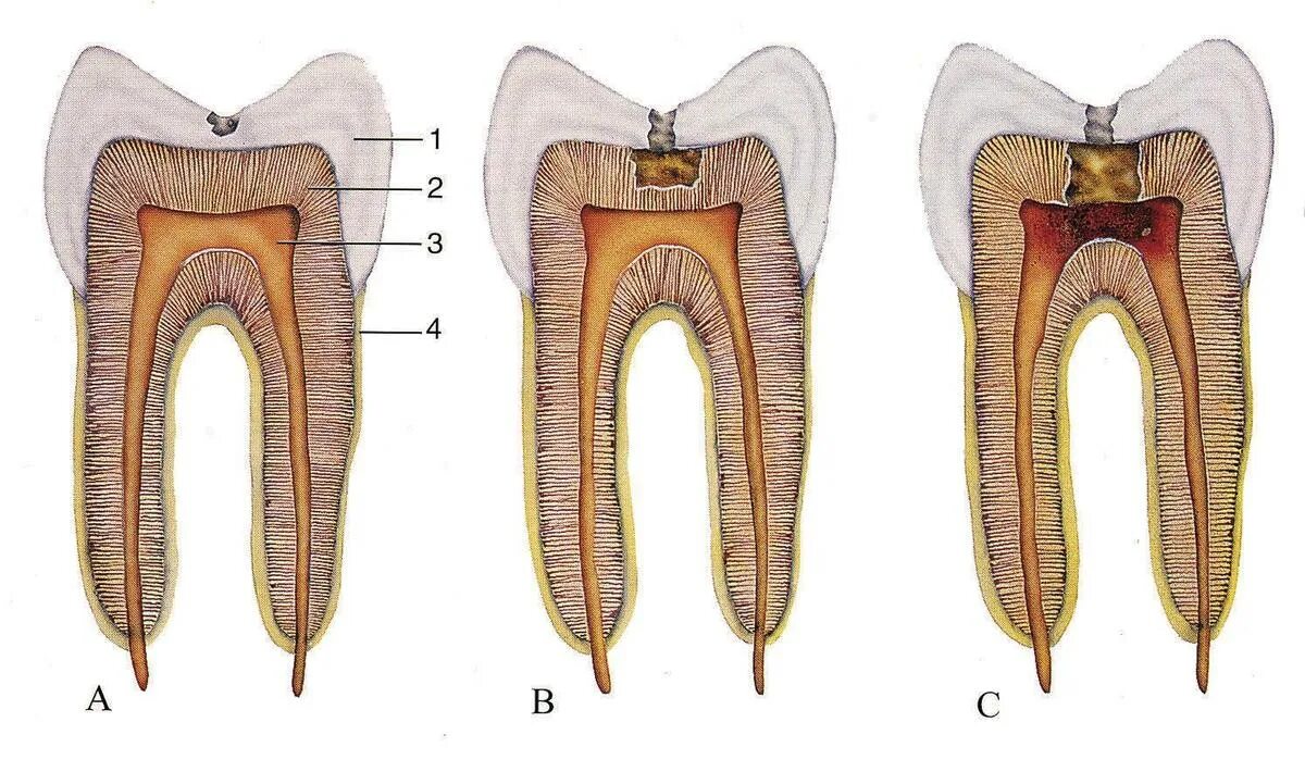 Кариес цемента кариес дентина кариес эмали. Кариес дентина глубокий.