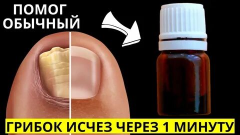 Избавиться от грибка навсегда