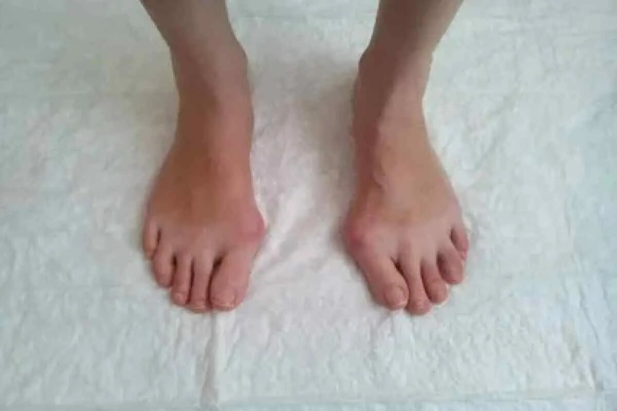 Продольный поперечный комбинированный плоскостопие. Поперечная деформация стопы. Продольное поперечное и комбинированное плоскостопие. Деформация стопы при поперечном плоскостопии. Поперечная деформация стопы.