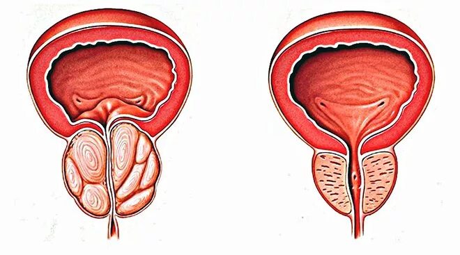 Аденома предстательной железы рисунок. Аденома предстательная железа у мужчин. Простит аденома простаты. Простатита гиперплазии предстательной железы