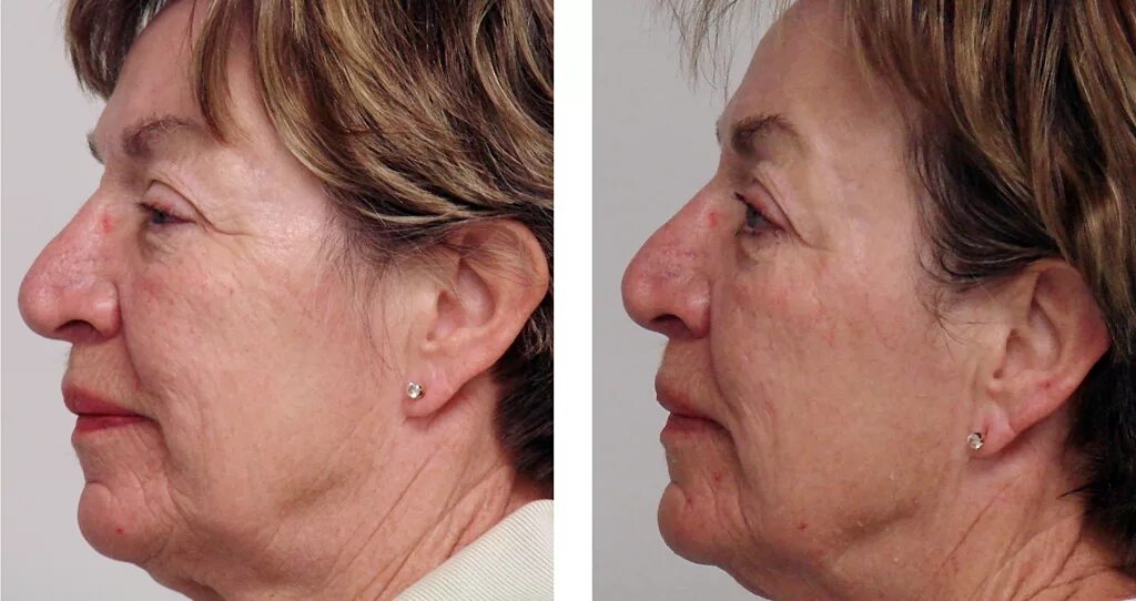 Лифтинг до после. Рф лифтинг до и после. Рф лифтинг до и после. Круговая пластика лица. Rf лифтинг до и после.