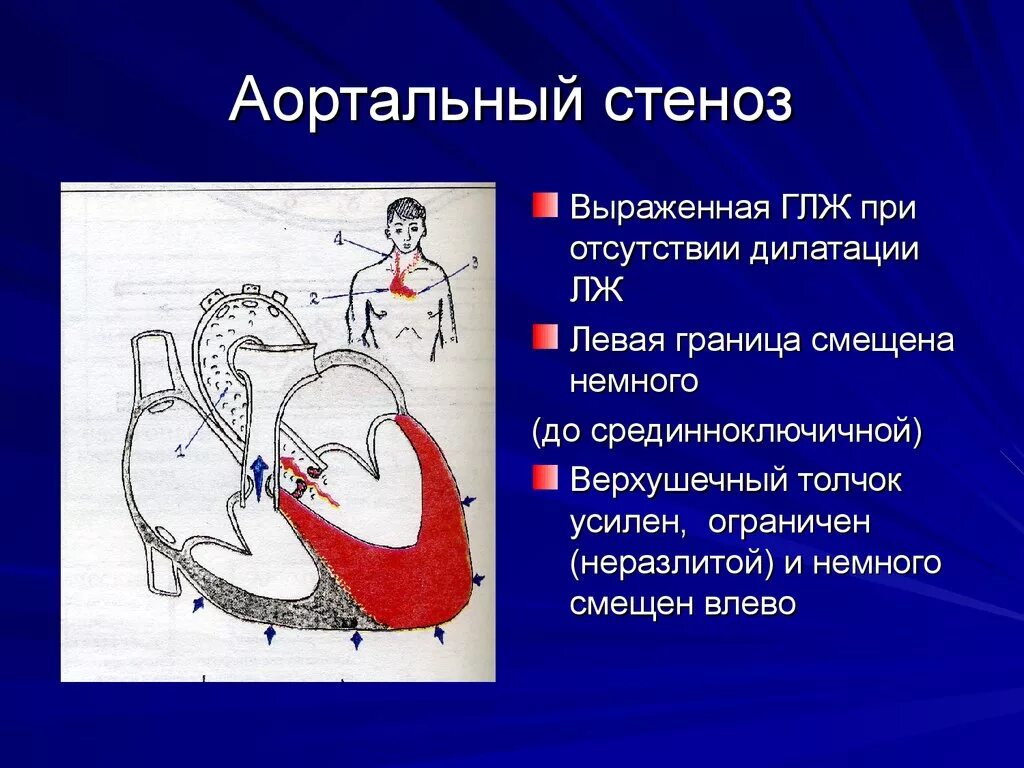 Аортальный стеноз что это такое. Стеноз устья аорты недостаточность. Порок сердца стеноз аортального клапана. Стенозе устья аорты гипертрофия. Изолированный артериальный стеноз.