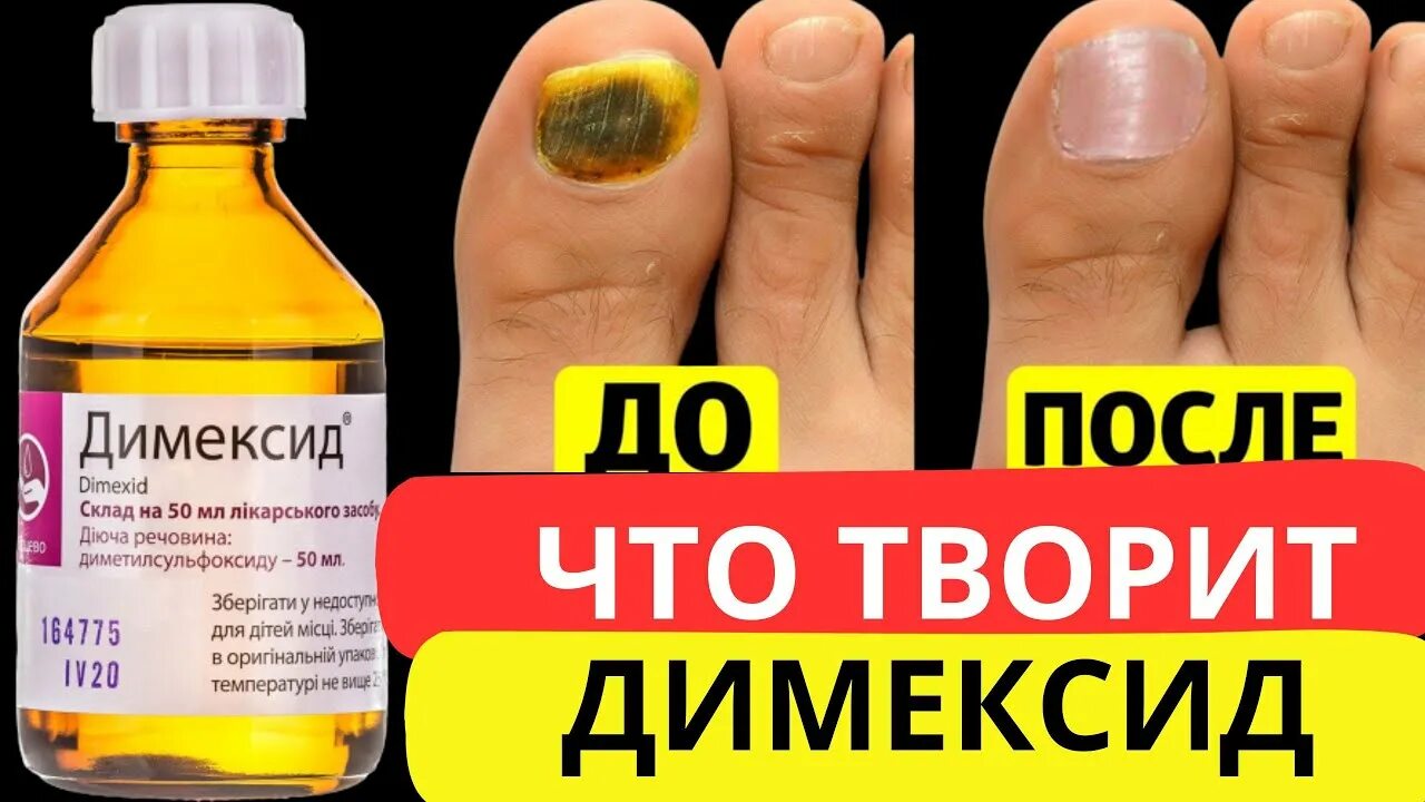 Как лечить ногти димексидом. Как лечить ногти димексидом