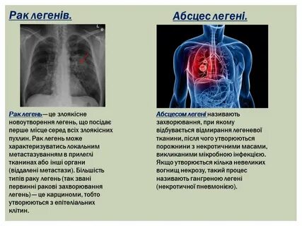 Легкие реферат
