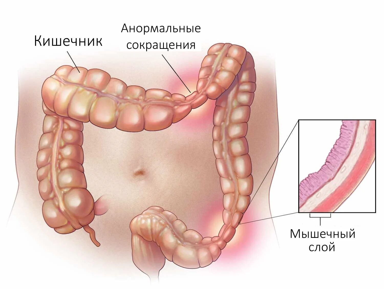 Синдром раздражения Толстого кишечника. Синдром раздраженного кишечника (СРК) симптомы. Синдром раздражённого кишечника (СРК). Синдром раздраженного кишечника толстой кишки симптомы.