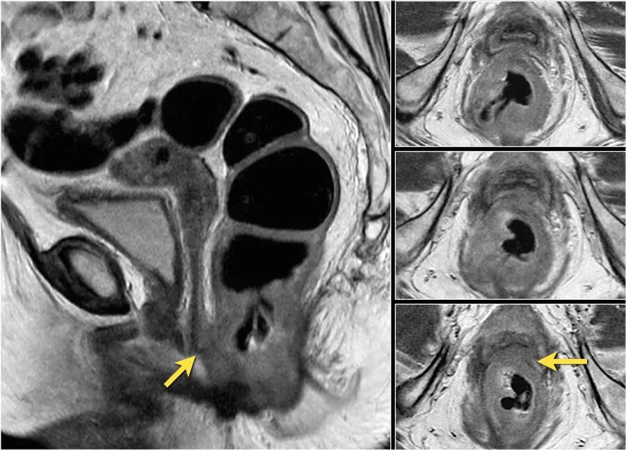 наружный генитальный эндометриоз мрт. опухоль сигмовидной кишки мрт. мрт малого таза прямая кишка. мрт малого таза прямая кишка. нижнеампулярный отдел прямой кишки мрт.