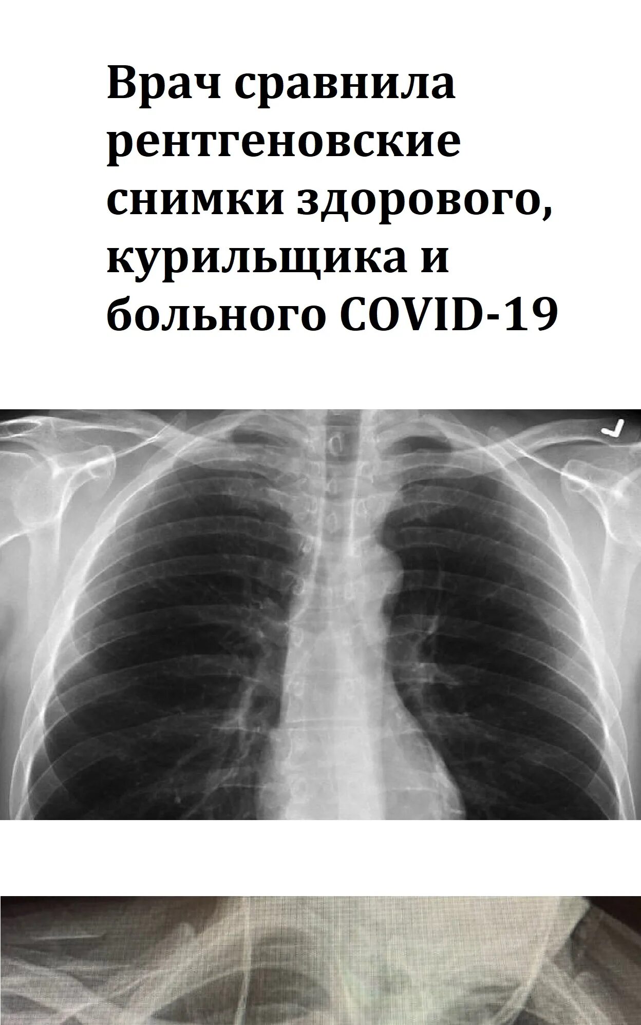 Флюорография видно ли курящего электронную сигарету. Лёгкие здорового человека и курильщика на рентгене. легкие курящего человека рентген. лёгкие курильщика на рентгене. легкие курильщика рентген.