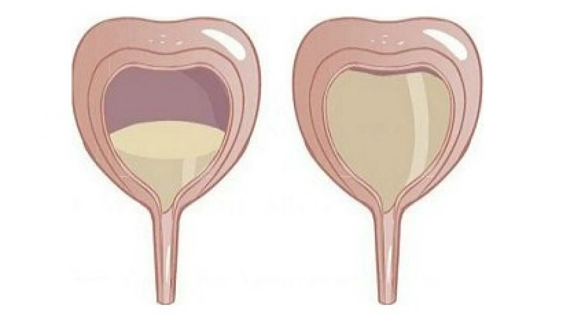 Расслабленный мочевой пузырь. Мочевой пузырь. Гиперактивный мочевой пузырь. Наполненный мочевой пузырь. Гиперрефлекторный мочевой пузырь.
