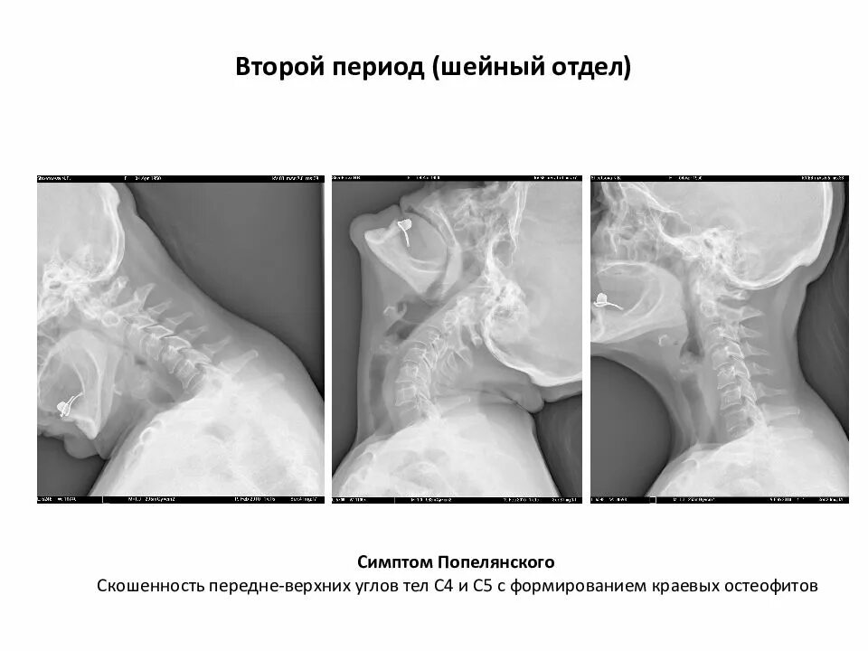 Персистирующий апофиз тела позвонка. Скошенность углов тел позвонков. Скошенность углов тел позвонков. Персистирующий апофиз тела позвонка рентген. Скошенность углов тел позвонков.