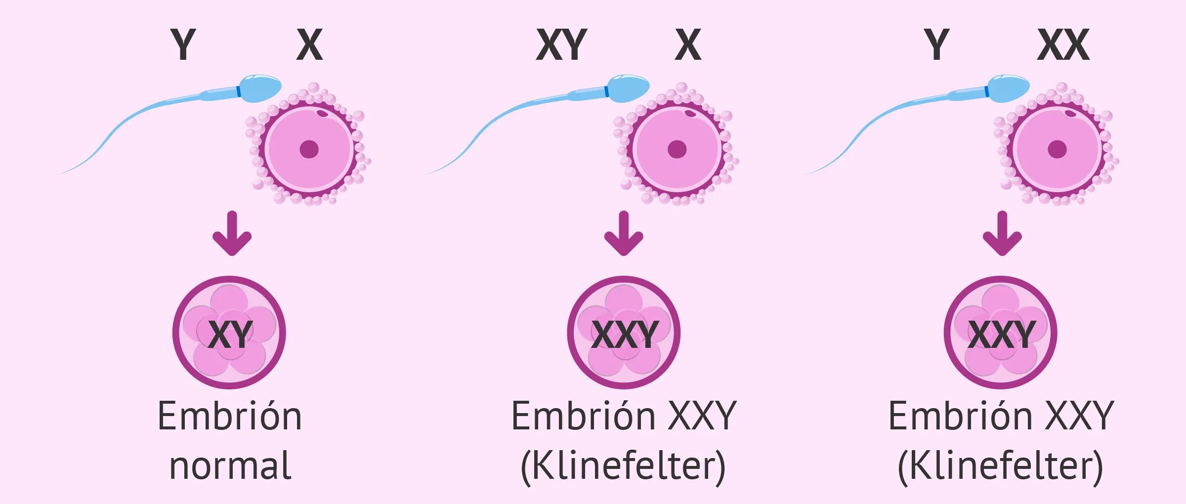 Xxy хромосома. Синдром Кляйнфельтера. Синдром Клайнфельтера схема. Синдром Клайнфельтера этиология. Xxy синдром Клайнфельтера.