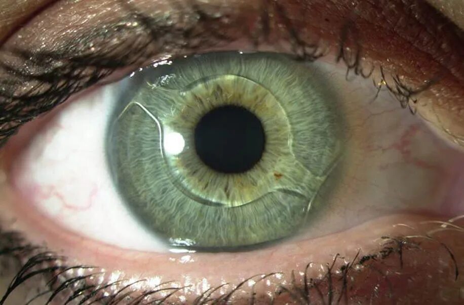 Линзы в глаза операция