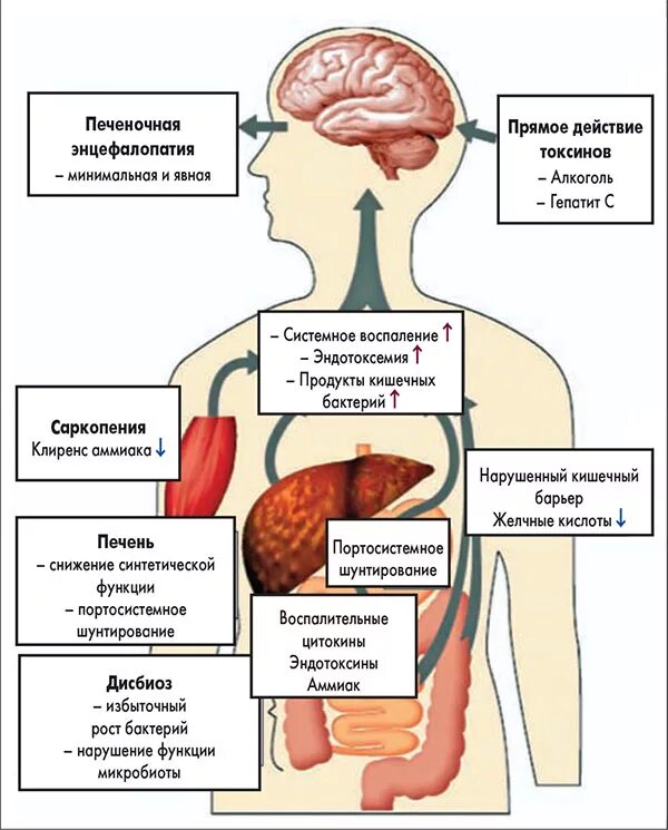 Печеночная энцефалопатия клинические симптомы. Патогенетическая терапия печеночной энцефалопатии. Синдром печеночной энцефалопатии этиология. Механизм развития печеночной энцефалопатии при циррозе печени. Стадии печеночной энцефалопатии