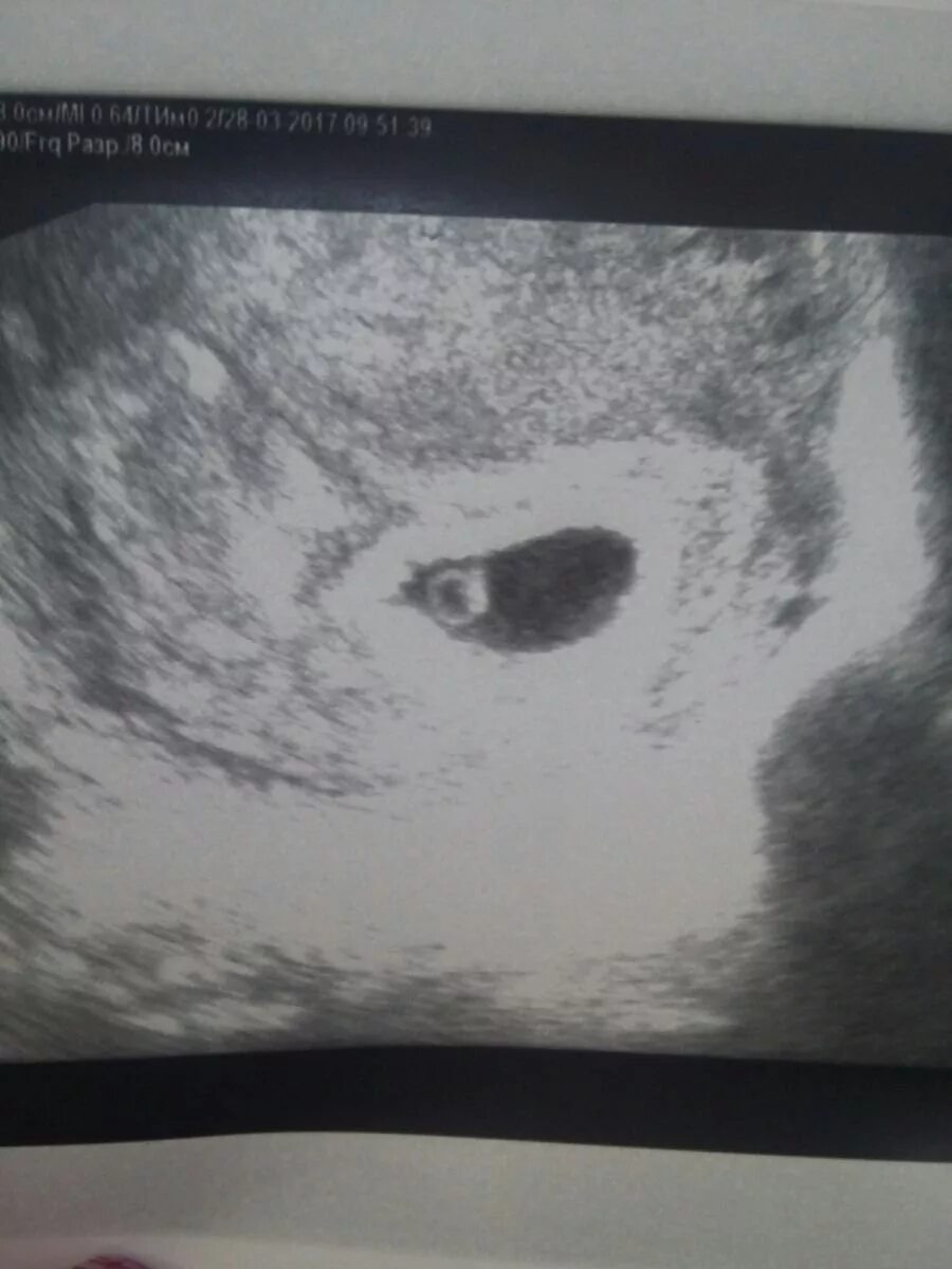 Узи на 5 акушерской неделе беременности. Узи на 4-5 неделе беременности акушерской. Анэмбриония с желточным мешком. Узи на 5 акушерской неделе беременности. Как выглядит узи 5 недель.