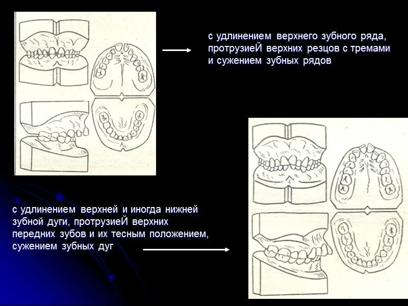 Кронштейн переднего амортизатора пружины шевроле нива. Удлинение верхнего. Самодельные рычаги на ваз 2107. Пластика десны до и после. Удлинение верхнего.