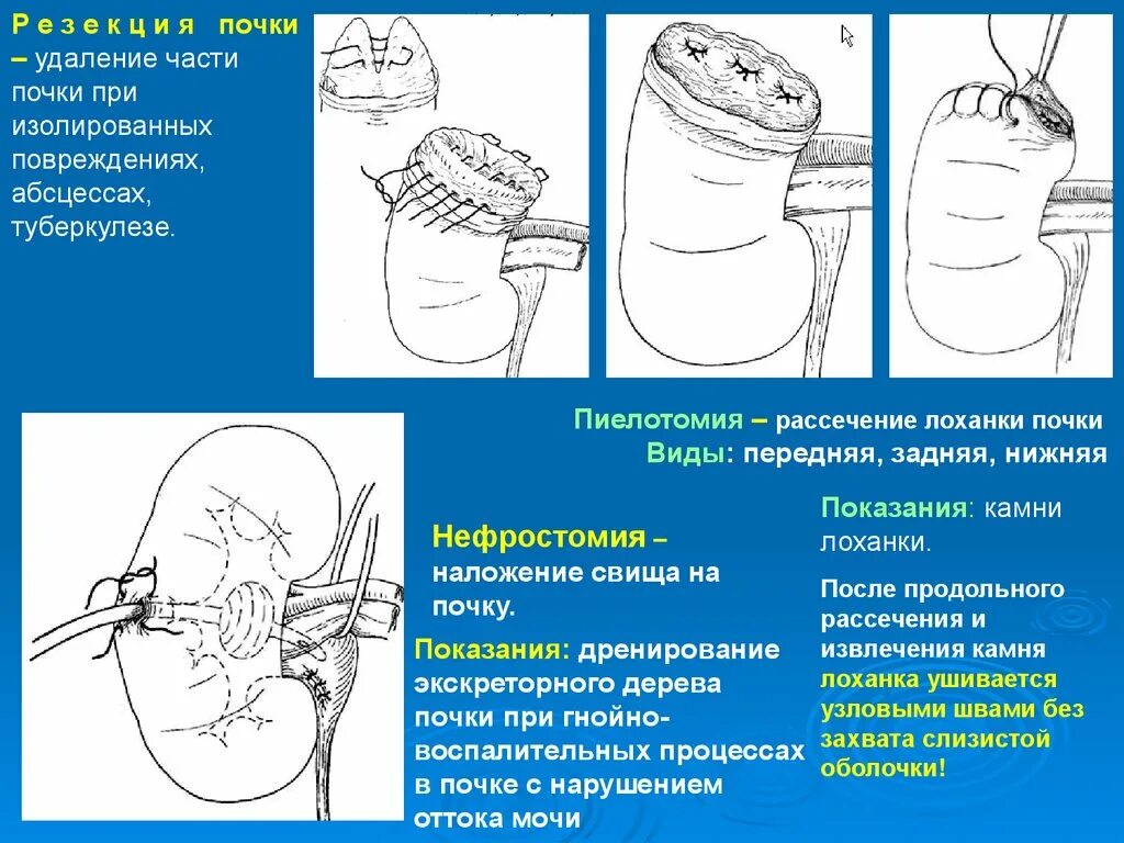 Операция на почки резекция почки.