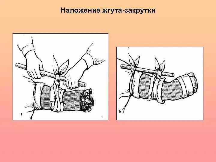 Наложение повязки закрутка. Наложение повязки закрутка. Наложение повязки закрутка. Артериальное кровотечение предплечья жгут. Техника наложения жгута эсмарха.