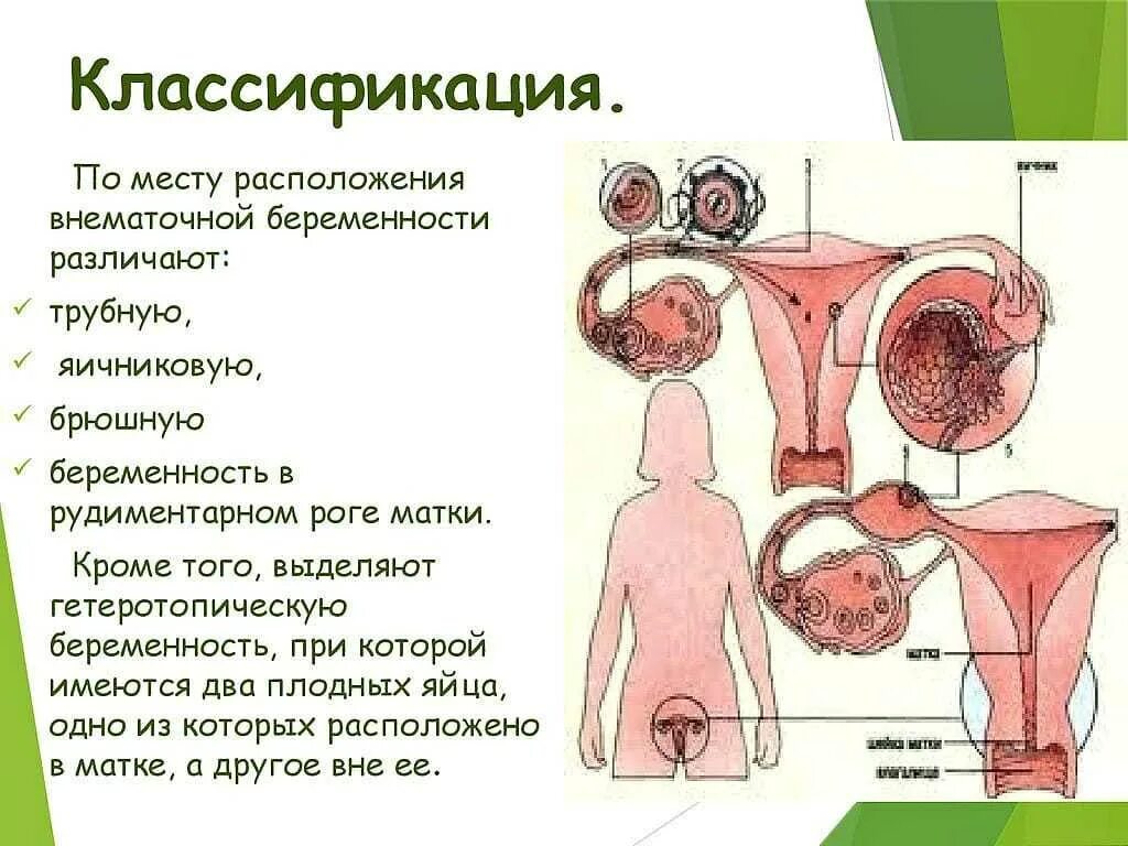 Почему происходит внематочная. Внематочная беременность. Внематочная беременность расположение. Причины внематочной беременности. Внематочная (эктопическая) беременность.