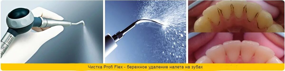Зубных отложений методом air flow. Профгигиена полости рта air flow. профгигиена (ультразвук + air-flow).