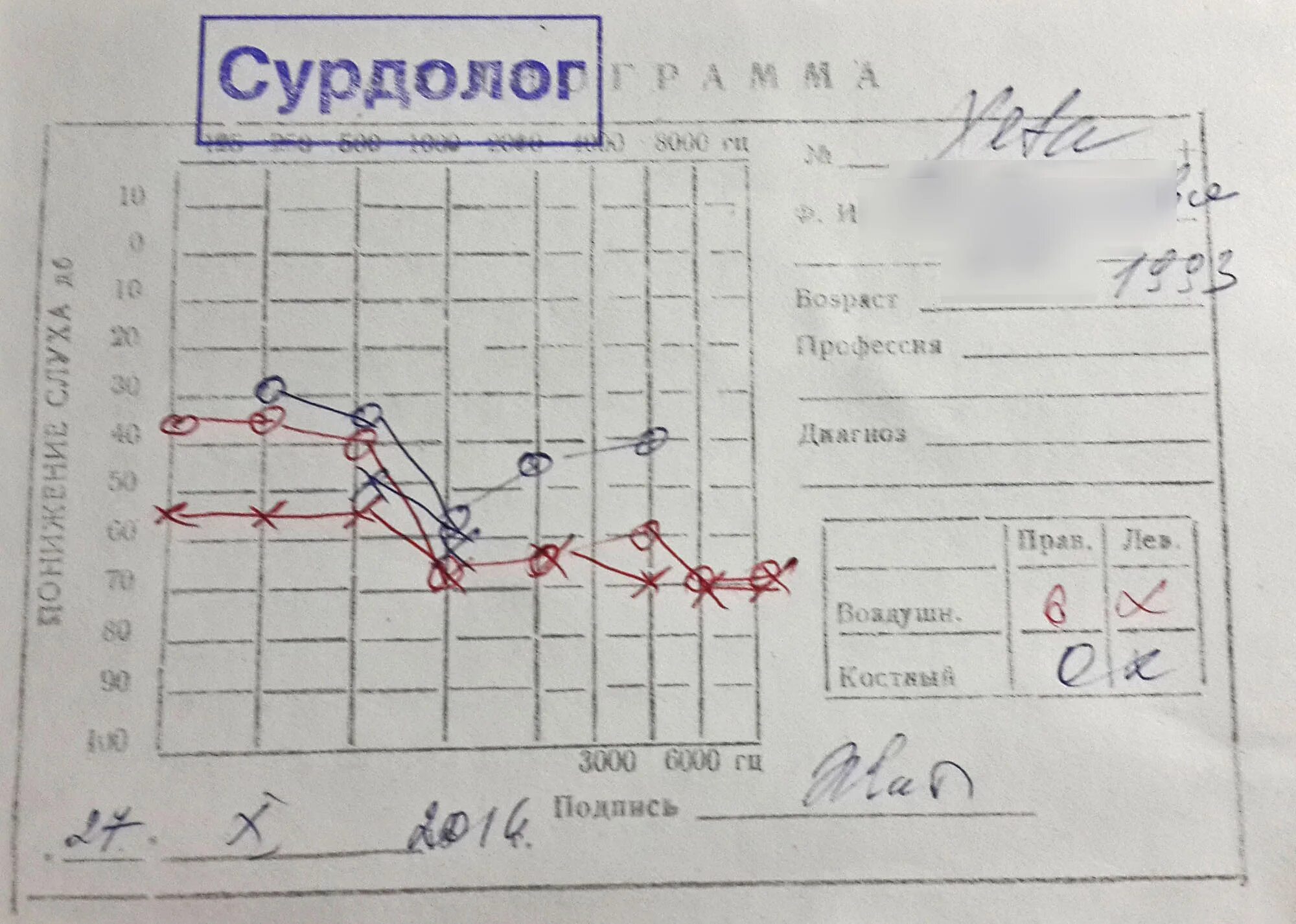 Аудиограмма слуха 3 степени. Аудиограмма 4 степени тугоухости. Аудиограмма 3 степени тугоухости. Аудиограмма слуха норма. Аудиограмма степени